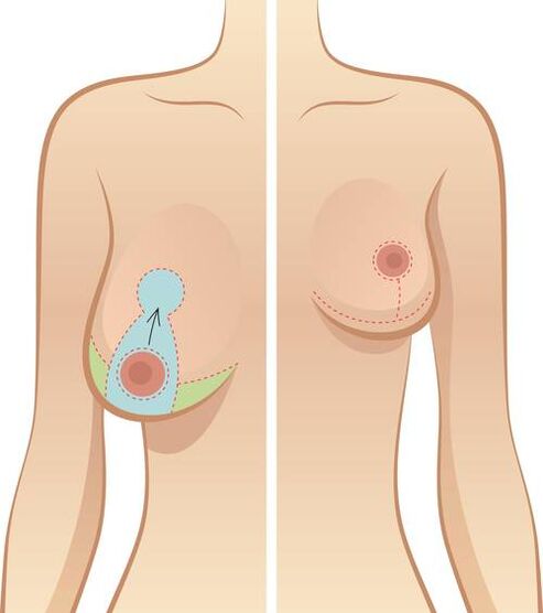 下垂的乳房是手术的指示