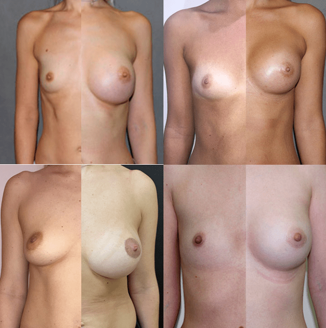 乳房乳房成形术前后的照片