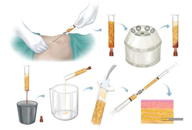 去除问题区域的脂肪，加工并注射到乳房组织中