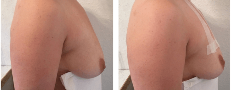 埋线乳房提升术前后