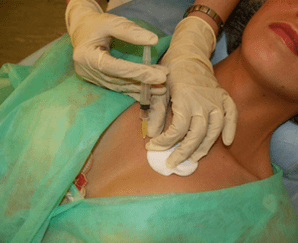 将内观混合物引入乳腺组织 - 透明质酸注射的替代方案